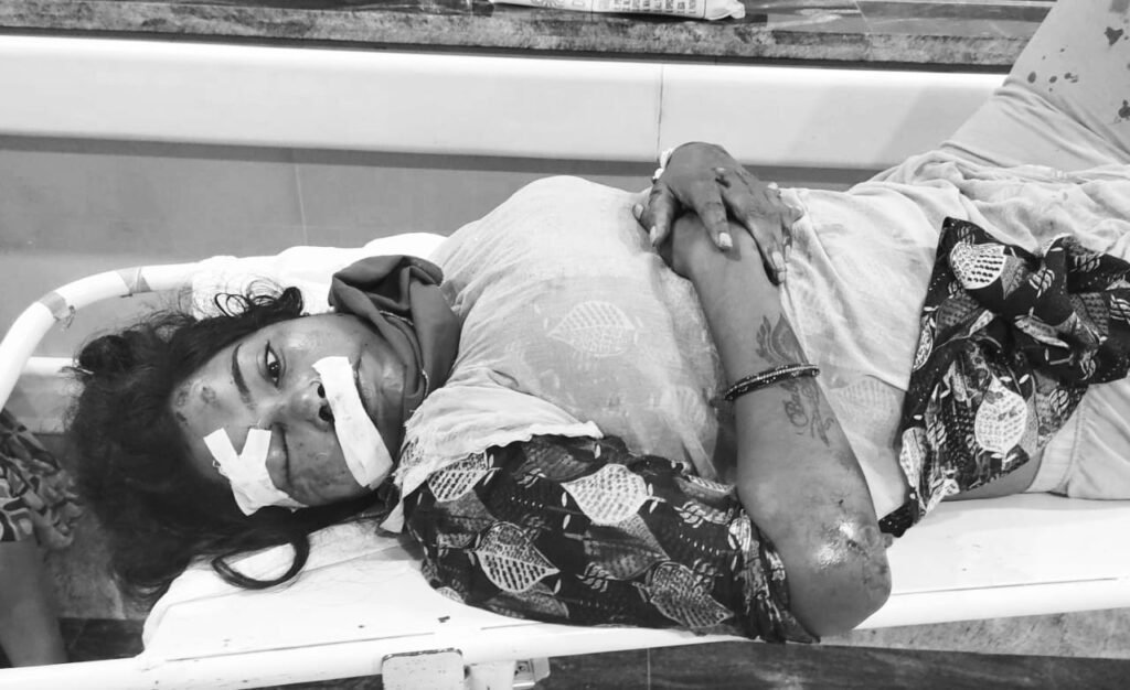 Jamshedpur : सर्किट हॉउस में स्कूटी सवार युवती को अज्ञात वाहन ने चपेट में लिया, बारीडीह की रहने वाली है घायल